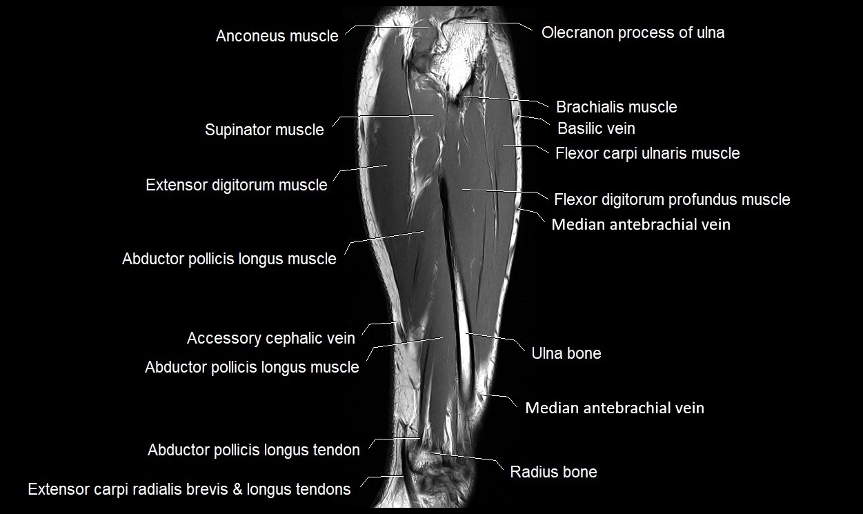 MRI 3T forearm coronal cross sectional anatomy image 20.webp